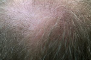 haarverlies door stress