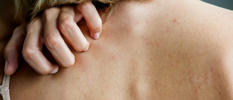 Last van eczeem door stress of burn-out? Dit kun je doen: