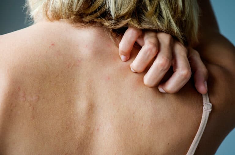 Ontstaat jeuk door stress? Is de oorzaak lichamelijk of geestelijk?