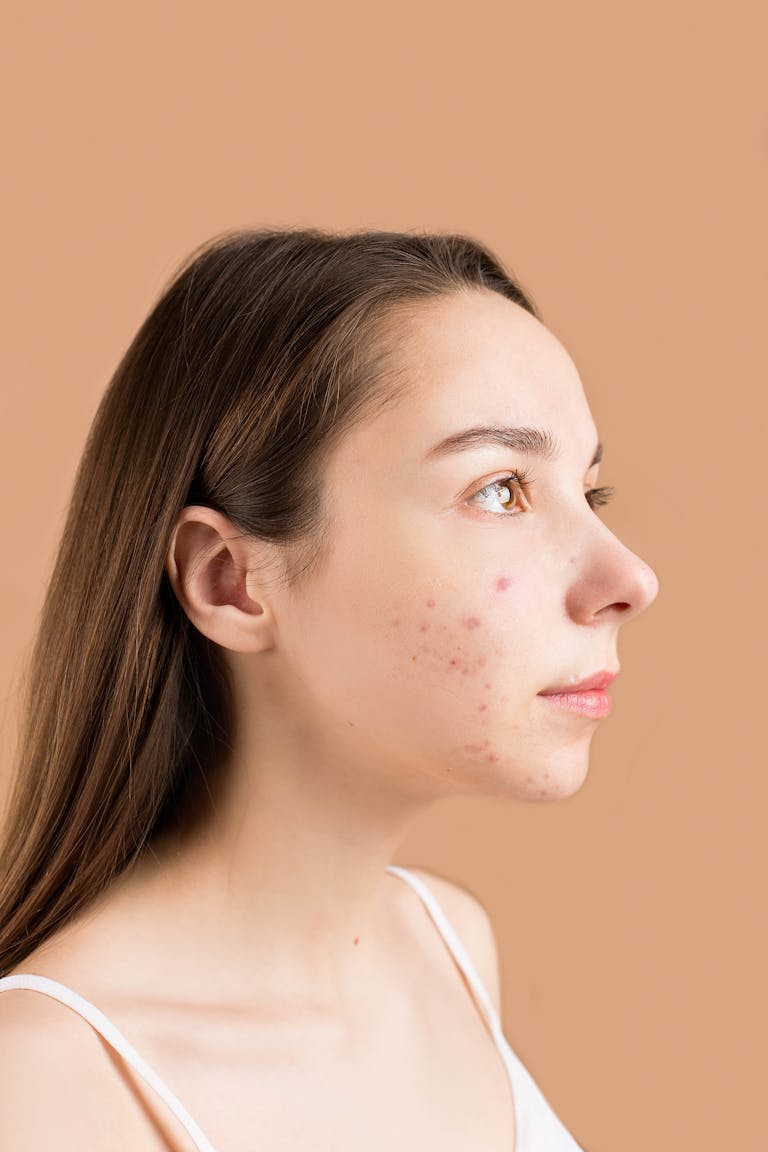 acne door stress